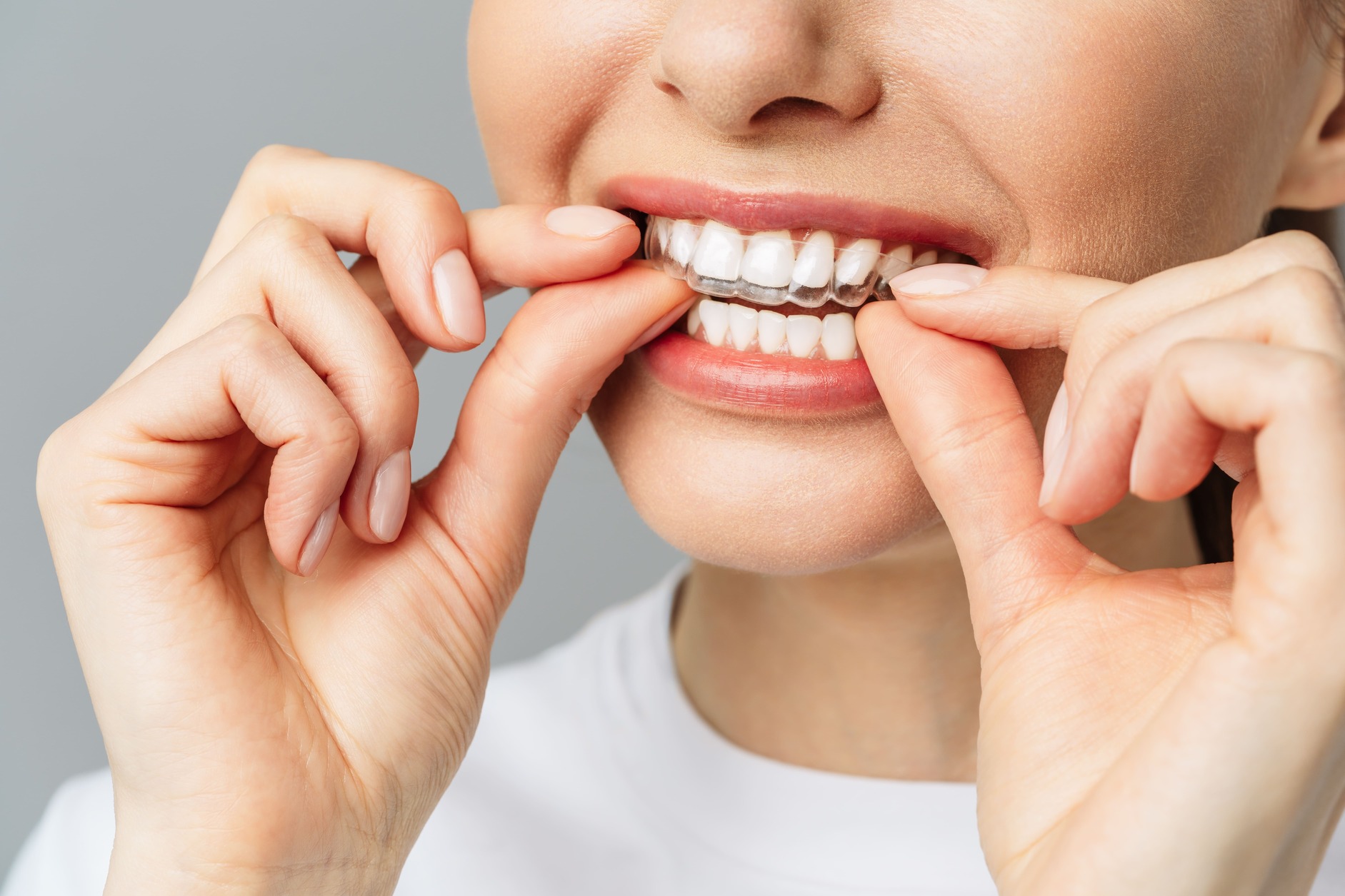 Invisalign beugel plaatsen Leidschendam