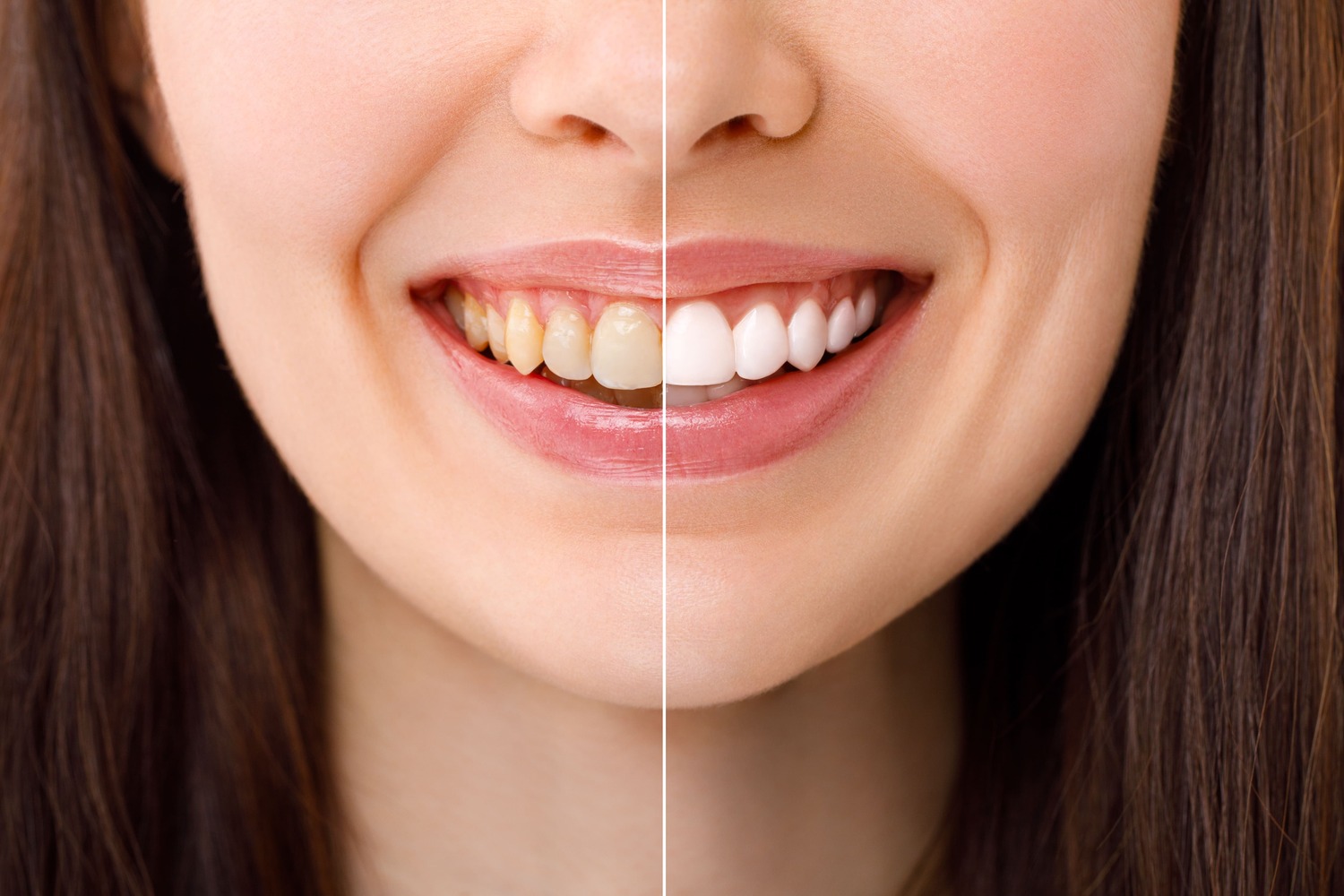 tanden-bleken-voor-en-na-foto