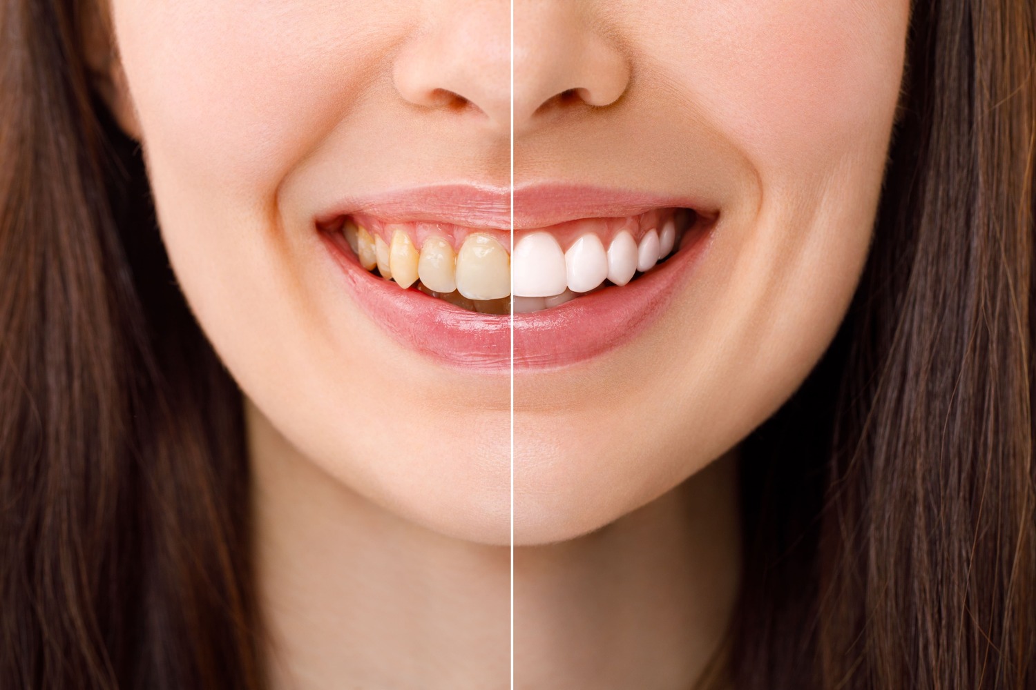 teeth whitening before and after photo